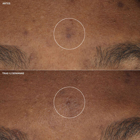 Even Better Clinical Bright Moisturizer